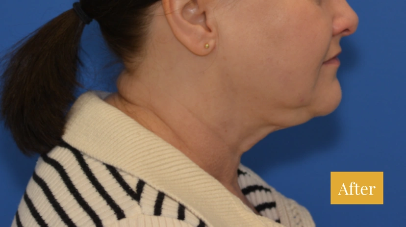 Facelift - Patient 13 - Set 1 - After