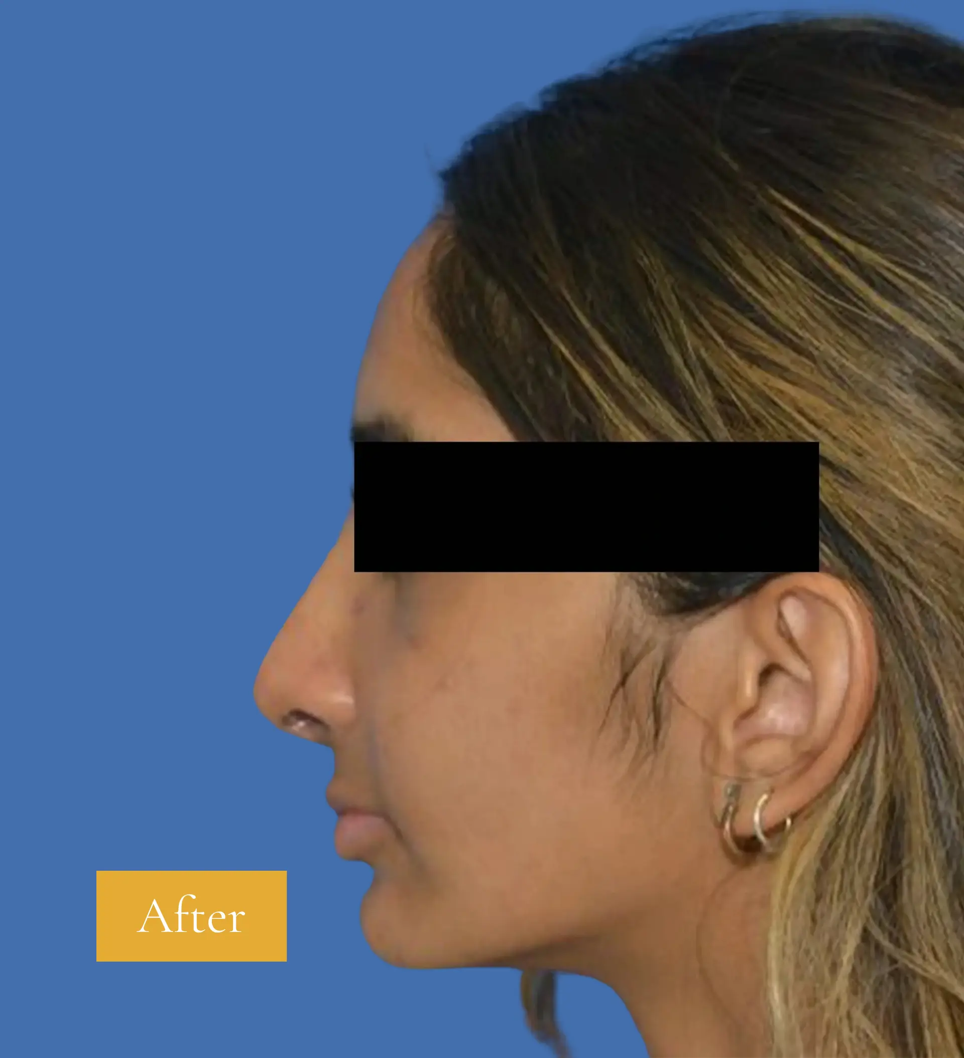 After Rhinoplasty before and after - Patient 7