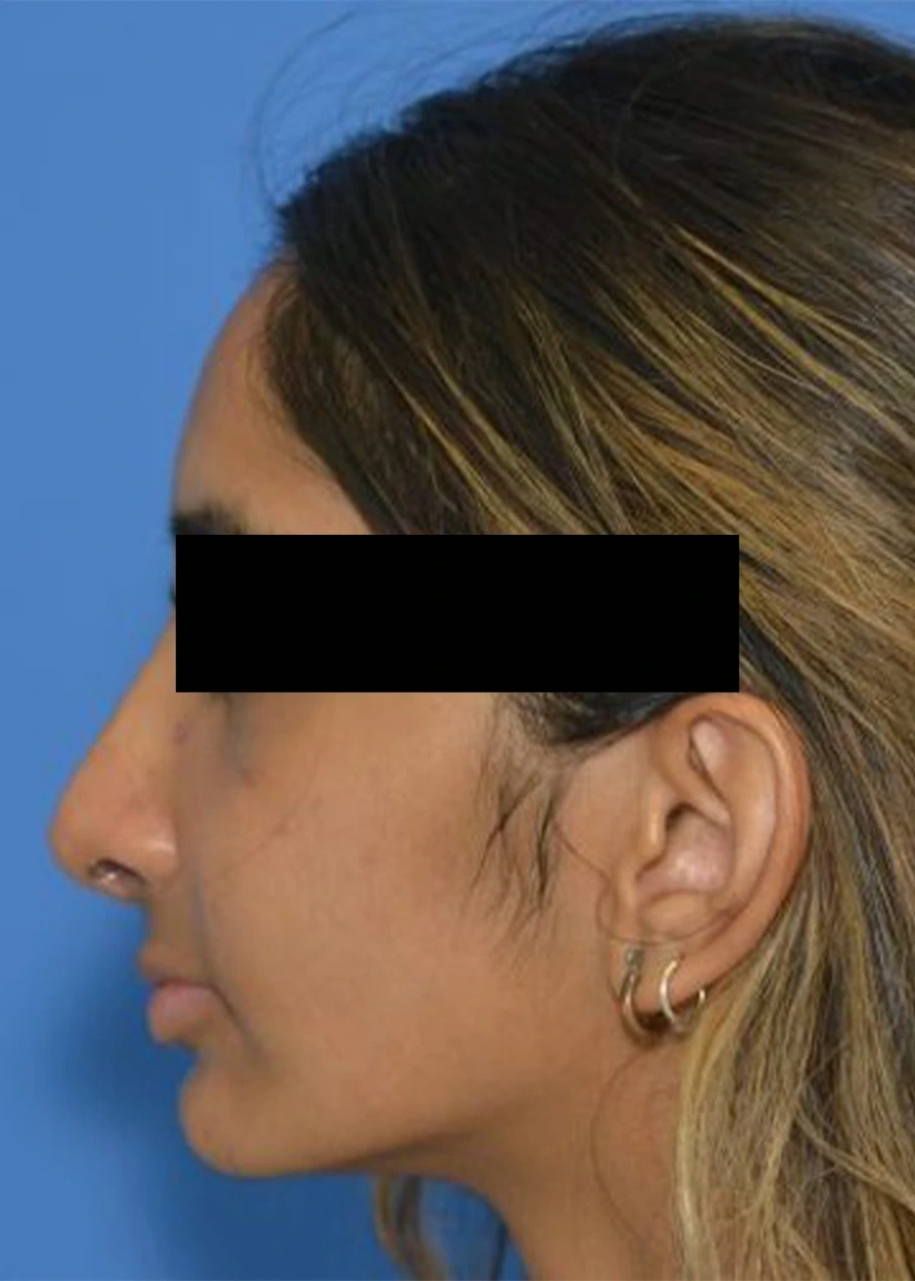 Rhinoplasty - Patient 7 (side view left after)