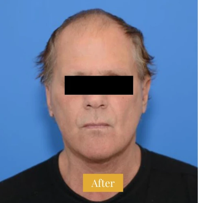 Mini Facelift/Short Scar - Patient 3 (front view after)