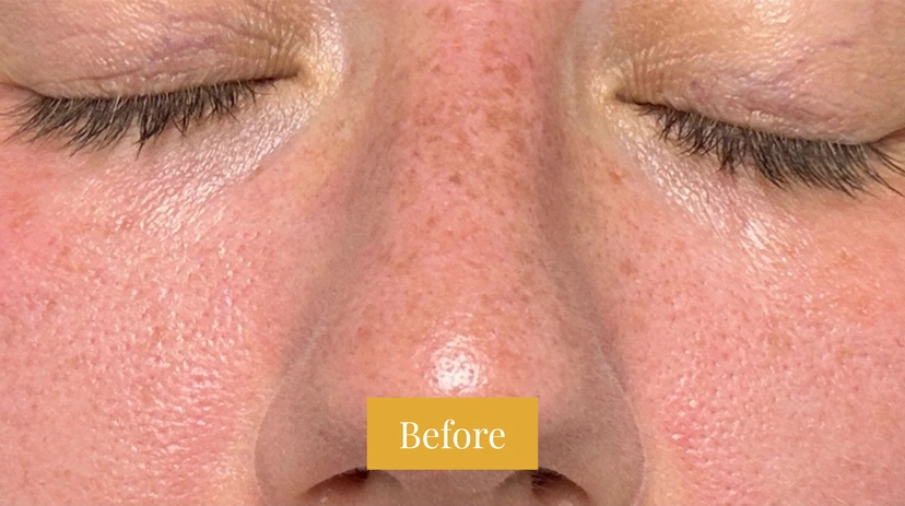 Fraxel - Patient 2 - Set 1 - Before