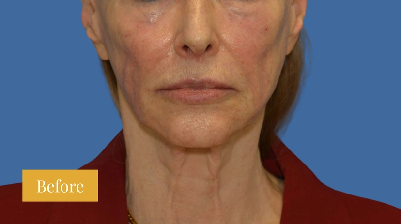 Dermal Fillers - Patient 5 - Set 1 - Before