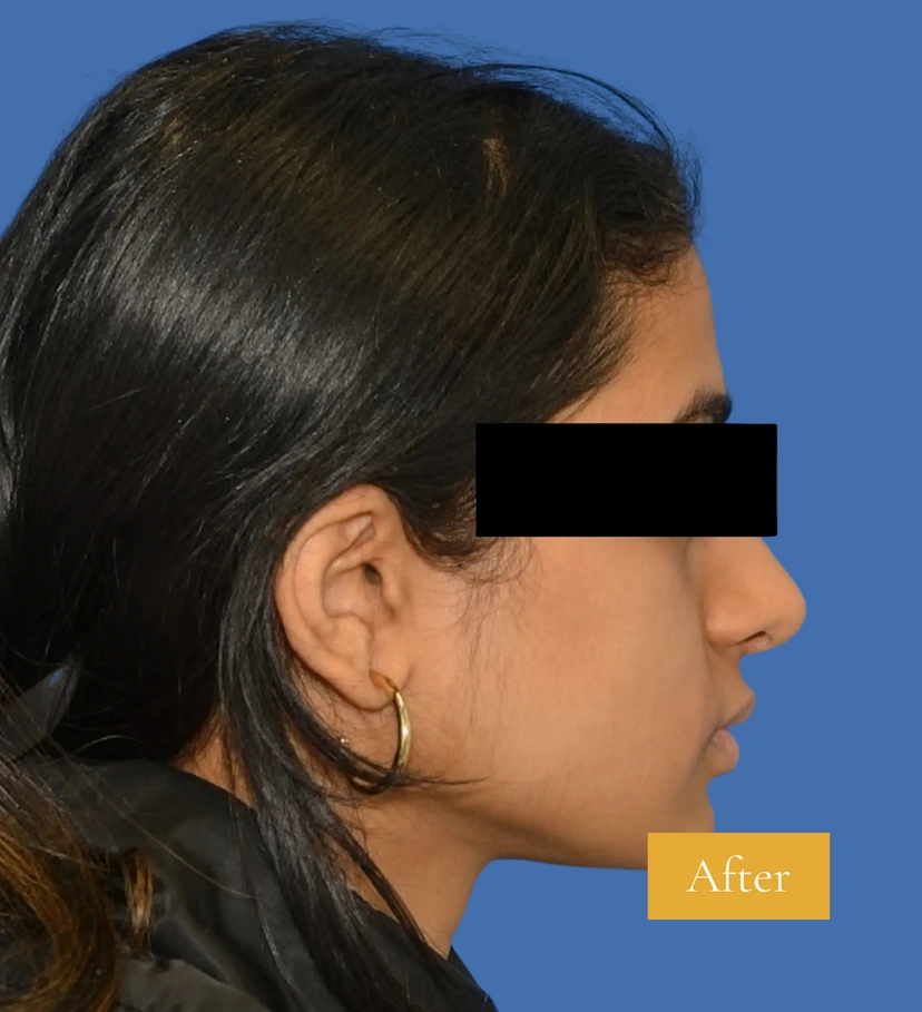 Rhinoplasty - Patient 6 (side view left after)