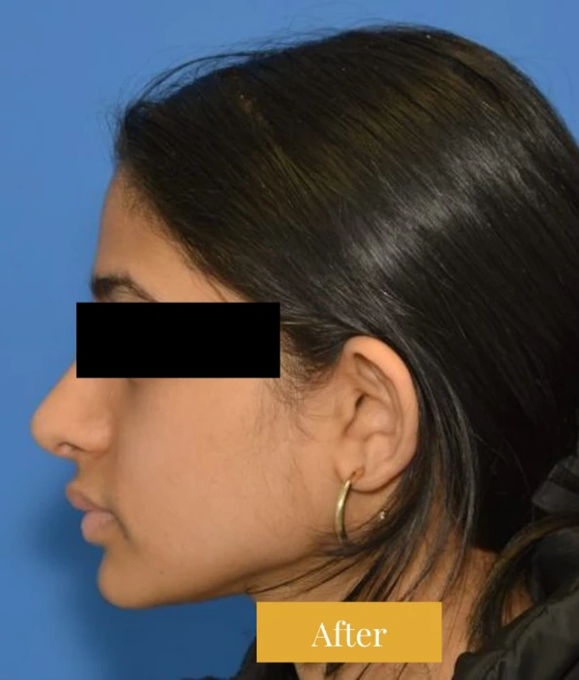 Rhinoplasty - Patient 6 (side view left after)