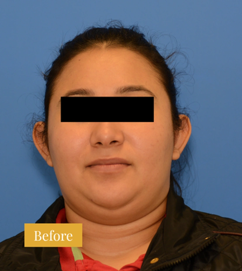 Otoplasty Ear Surgery - Patient 2 - Before