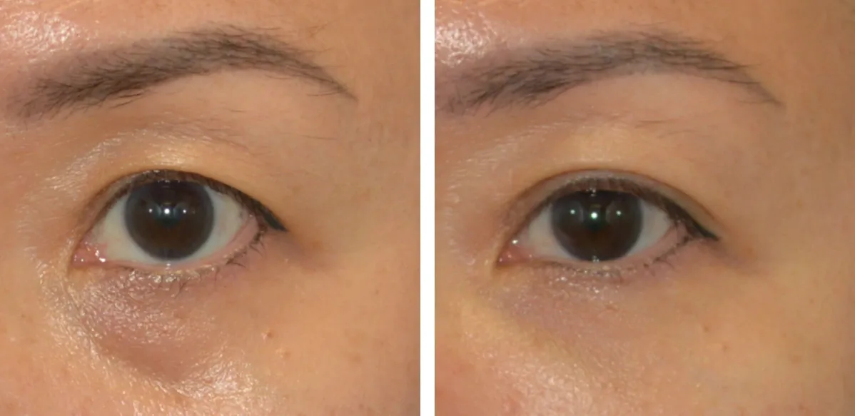 Blog Our Hottest Summer Treatments Img2