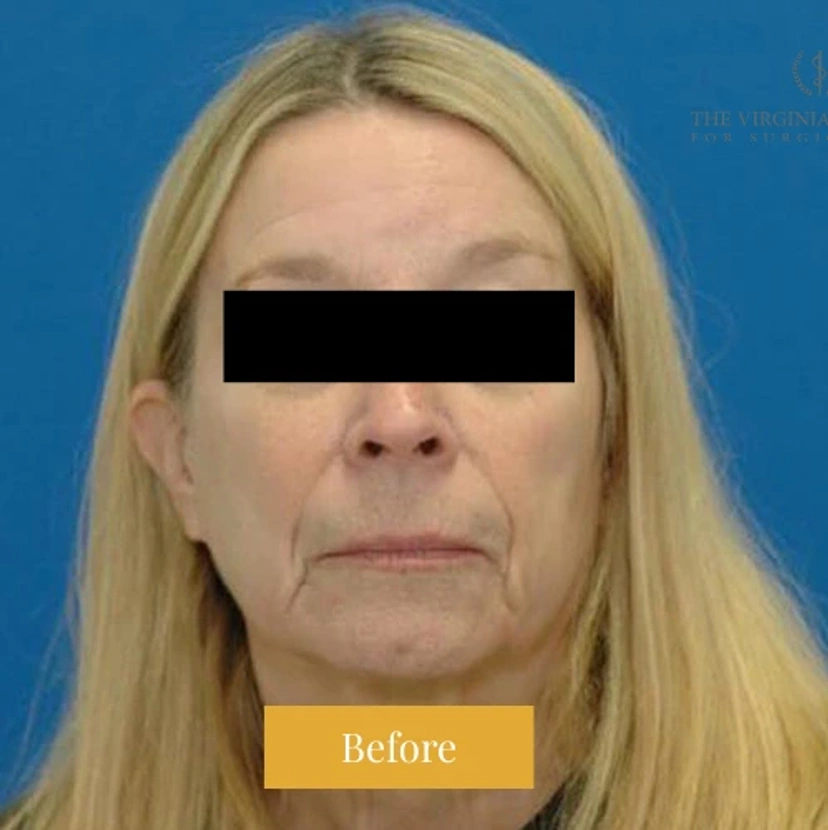 Mini Facelift/Short Scar - Patient 2 (before)