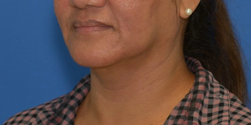 Morpheus8 RF Microneedling - Patient 3 (before)