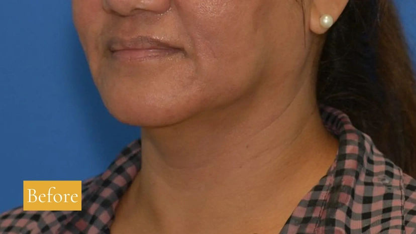 Morpheus8 RF Microneedling - Patient 3 (before)