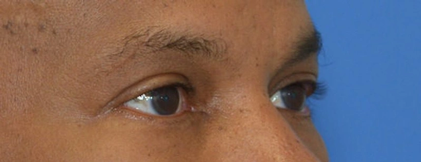 Lower Eyelid Surgery - Patient 4 (after)