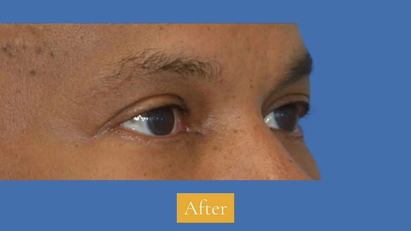 Lower Eyelid Surgery - Patient 4 (after)