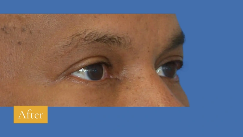 Lower Eyelid Surgery - Patient 4 (after)