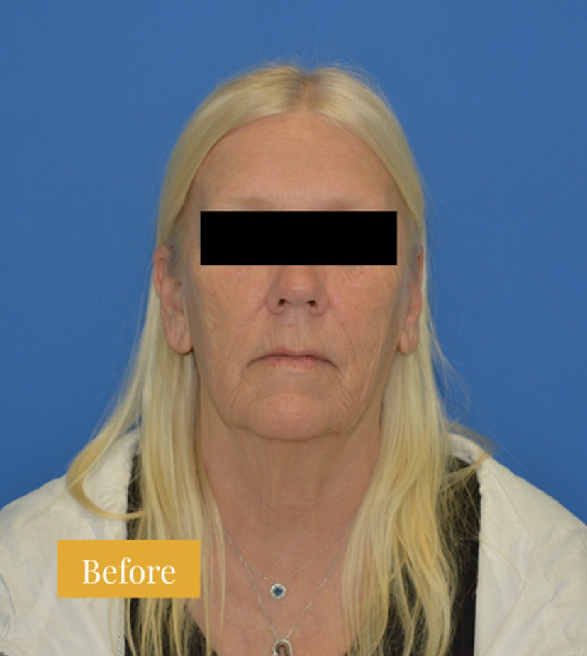 Facelift - Patient 12 - Set 1 - Before