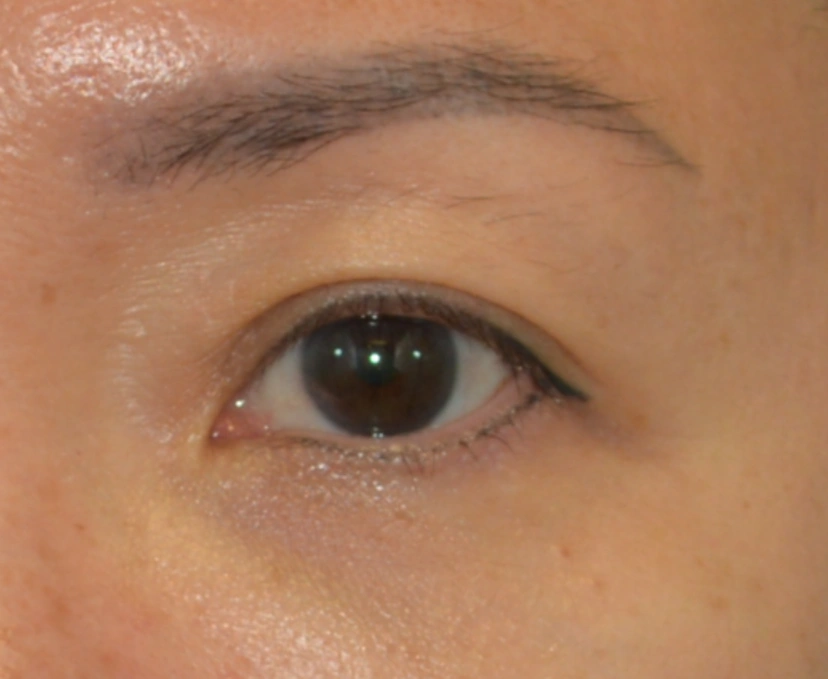 Asian eyelid surgery patient 52 result photo