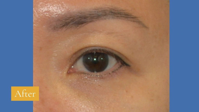 Asian eyelid surgery patient 52 result photo