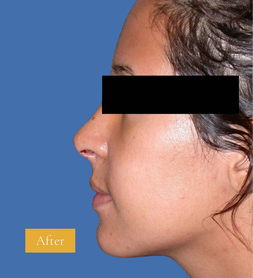 Rhinoplasty - Patient 1 (after)