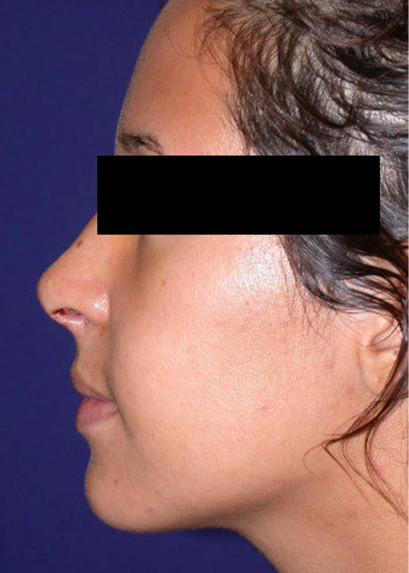 Rhinoplasty - Patient 1 (after)