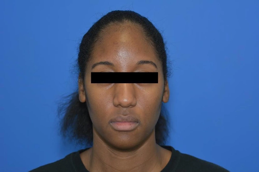 Microneedling - Patient 3 (before)