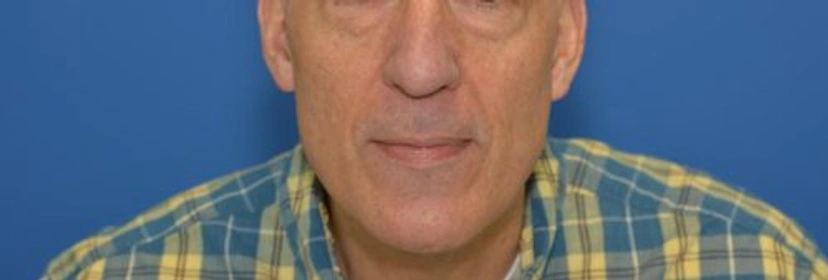 Dermal Fillers - Patient 2 (before)