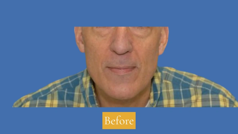 Dermal Fillers - Patient 2 (before)