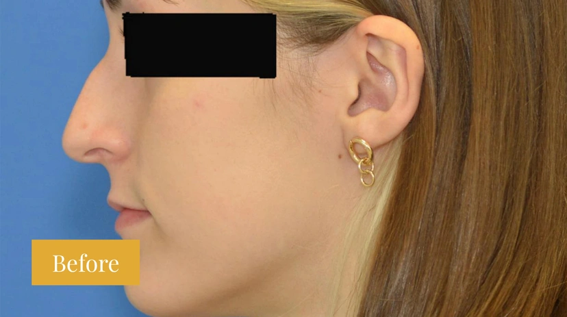 Rhinoplasty - Patient 11 - Set 1 - Before