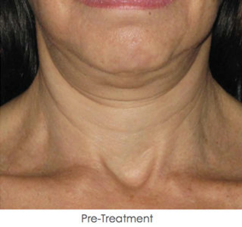 Asian eyelid surgery patient 3 result photo