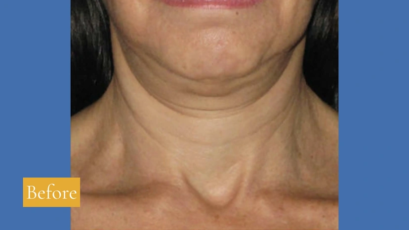 Asian eyelid surgery patient 3 result photo