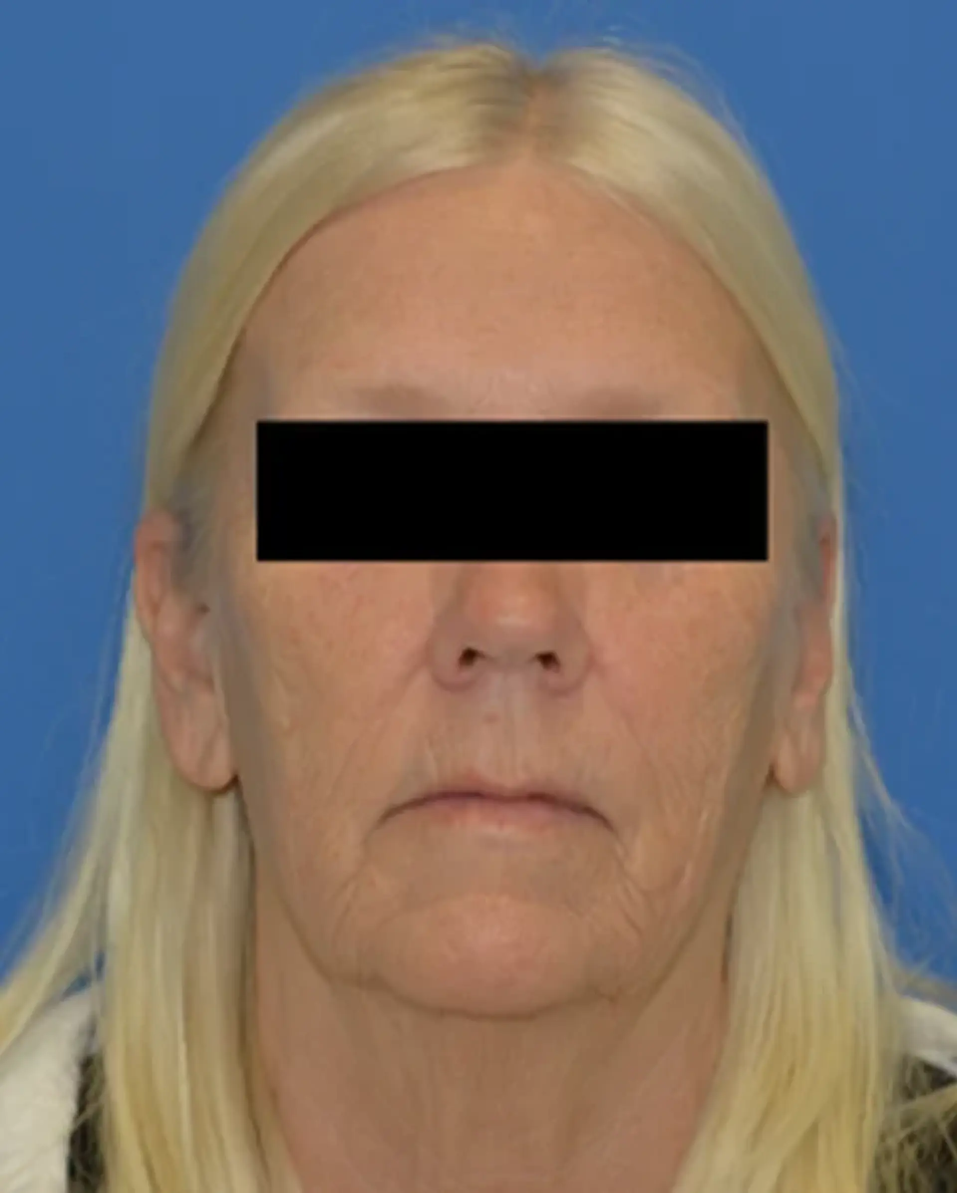 Before Facelift before and after