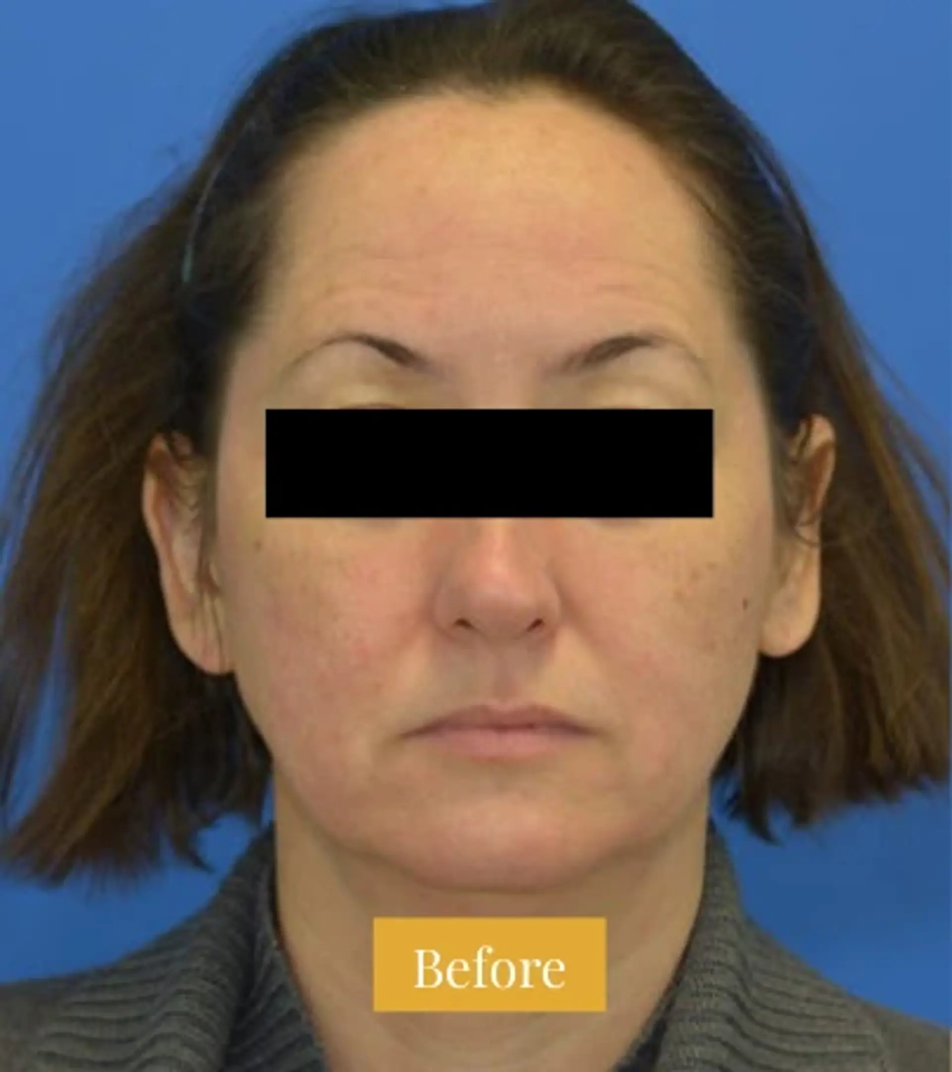 Before Mini Facelift before and after