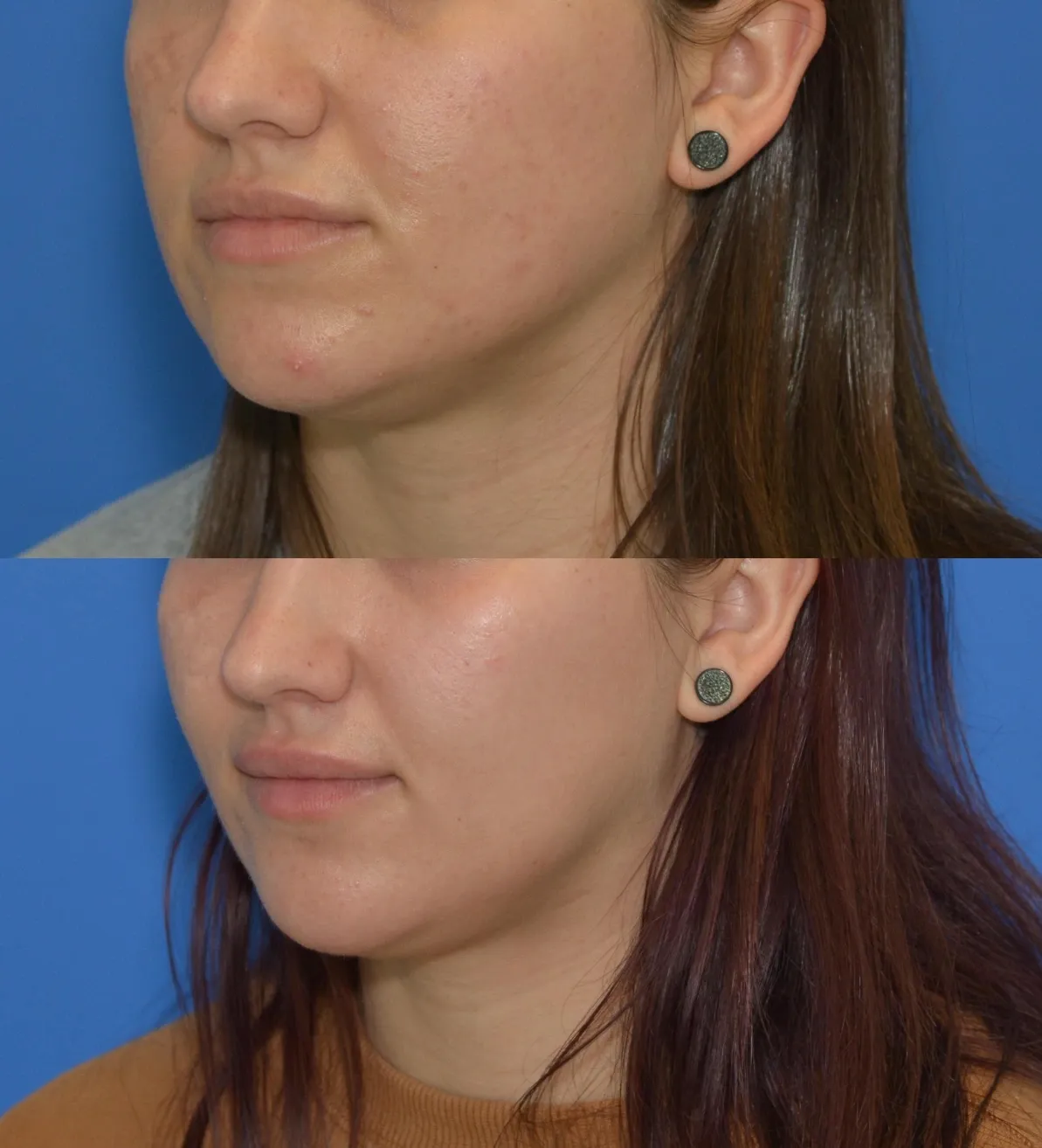 Blog How Combat Acne Scarring Microneedling Img2