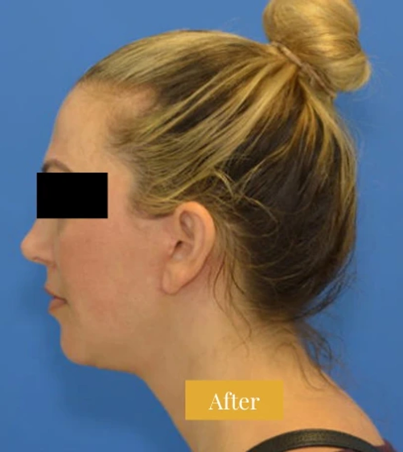 Mini Facelift/Short Scar - Patient 7 (after)