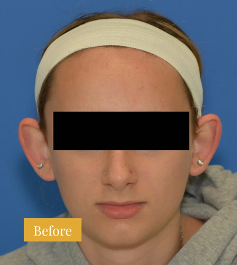 Otoplasty Ear Surgery - Patient 3 - Set 1 - Before