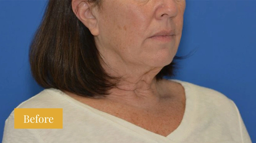 Facelift - Patient 10 - Set 1 - Before