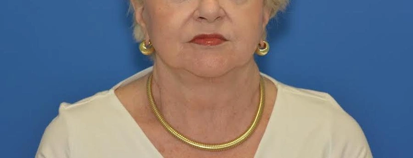 Morpheus8 RF Microneedling - Patient 5 (after)