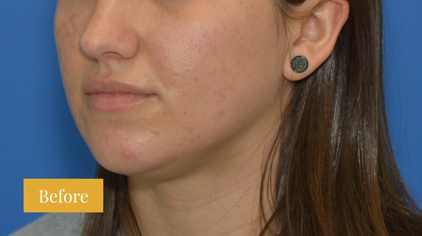 Microneedling - Patient 5 - Set 1 - Before