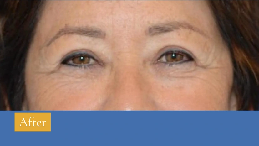 Upper Eyelid Surgery - Patient 3 (front view after)