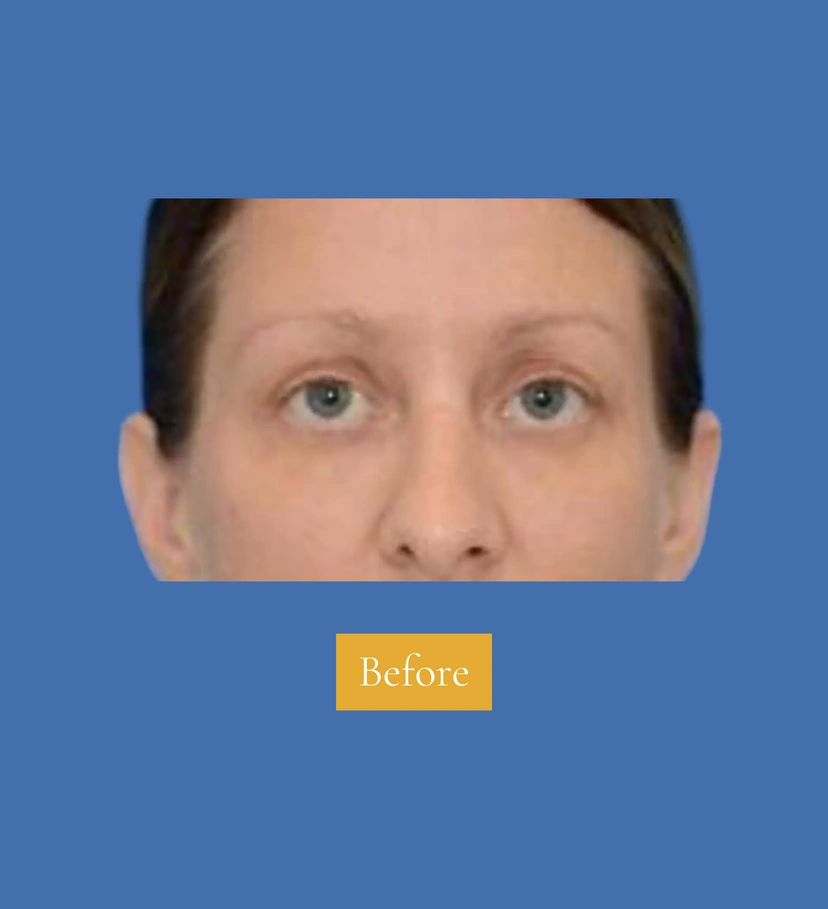 Lower Eyelid Surgery - Patient 2 (front view before)