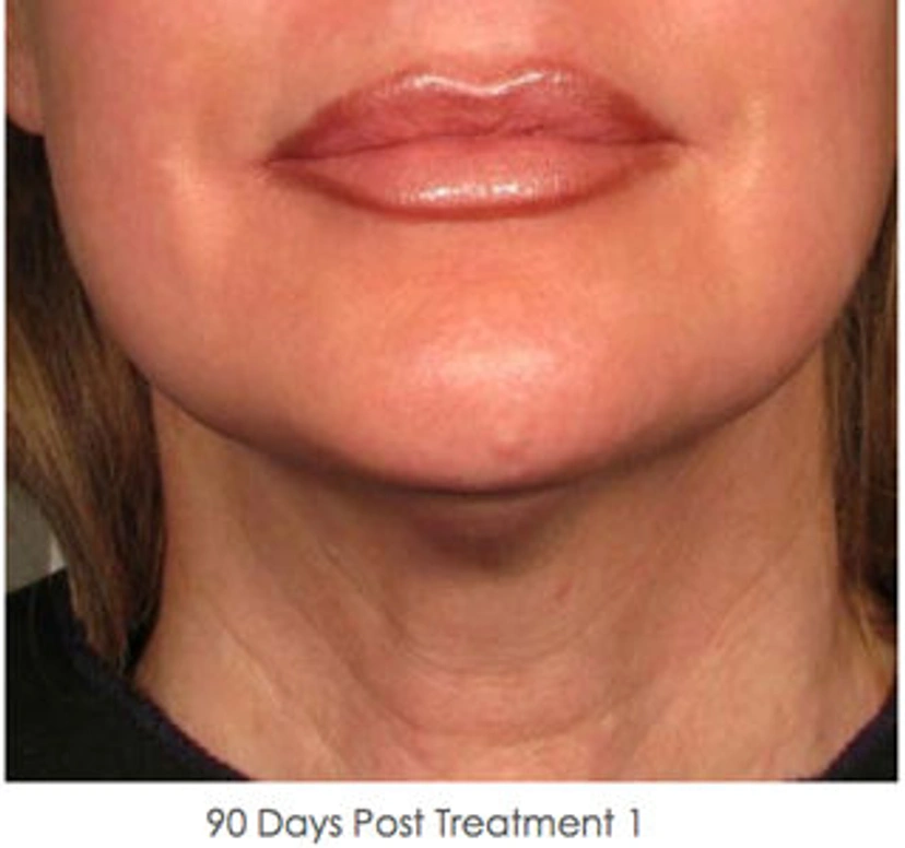 Ultherapy patient 5 result photo