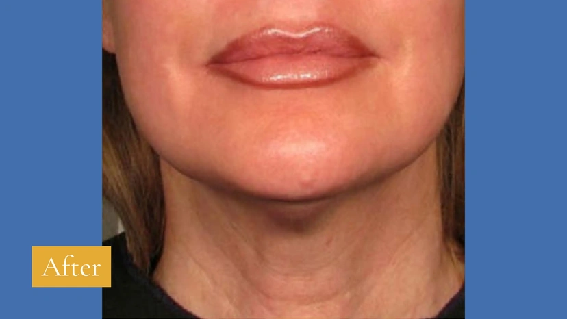 Ultherapy patient 5 result photo