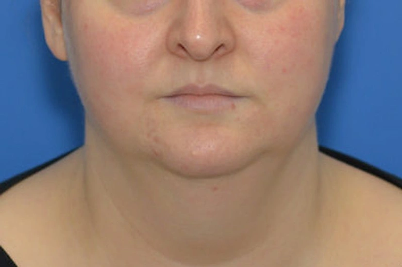 Morpheus8 RF Microneedling - Patient 10 (before)
