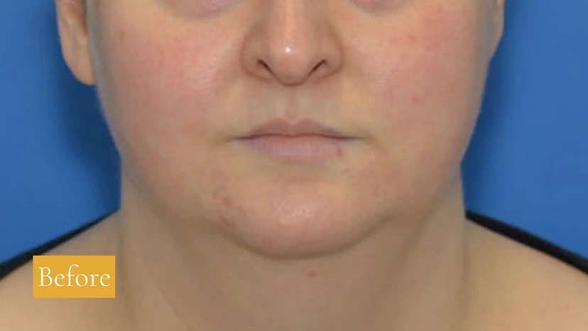 Morpheus8 RF Microneedling - Patient 10 (before)