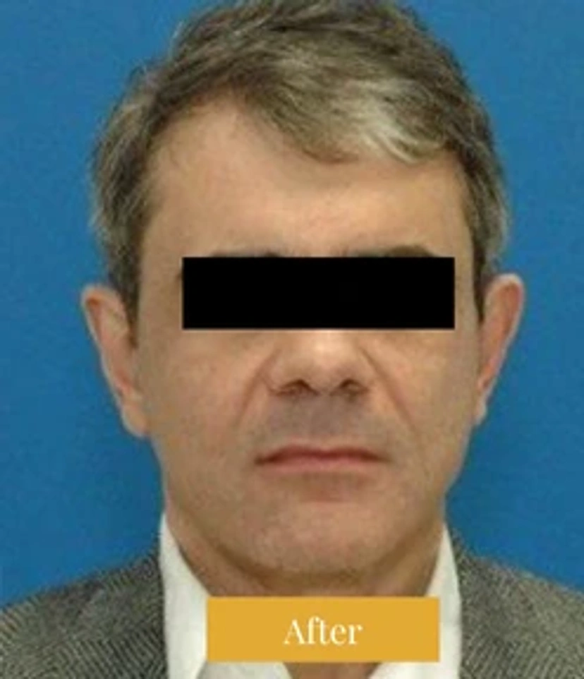 Mini Facelift/Short Scar - Patient 1 (after)