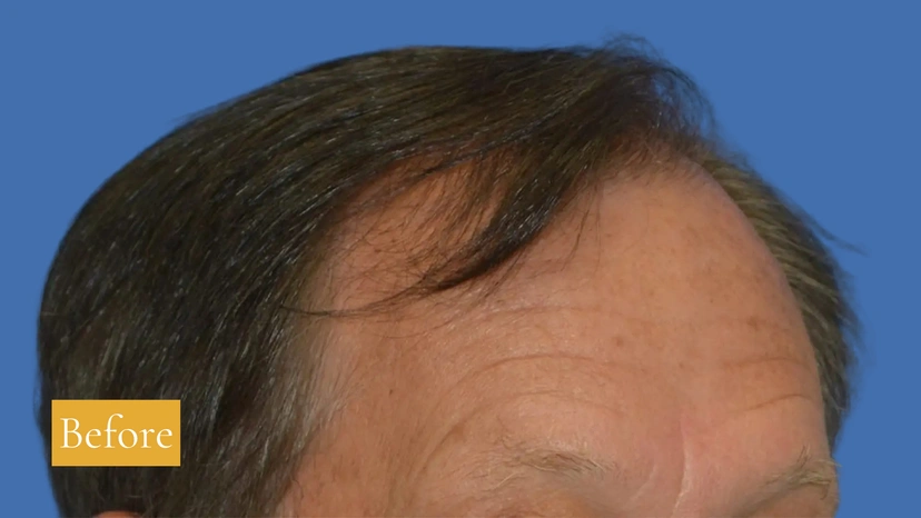 Botox - Patient 3 (before)
