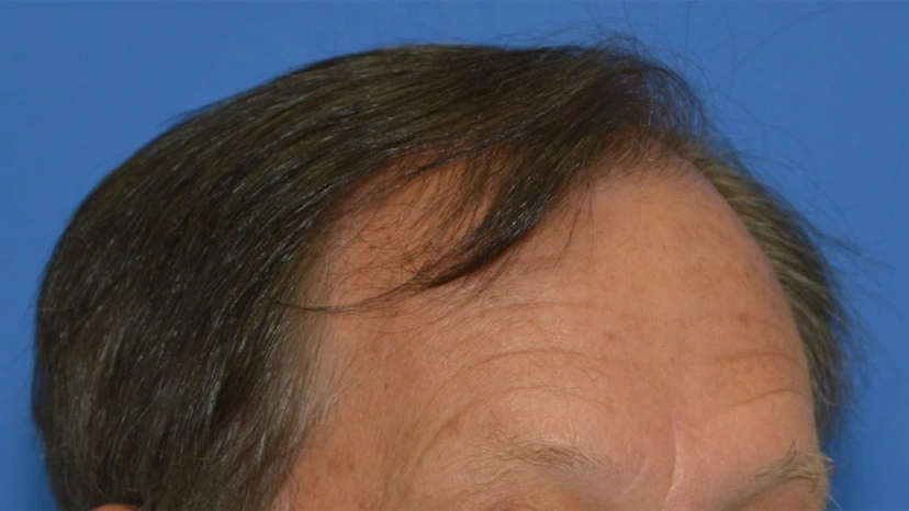 Botox - Patient 3 (before)