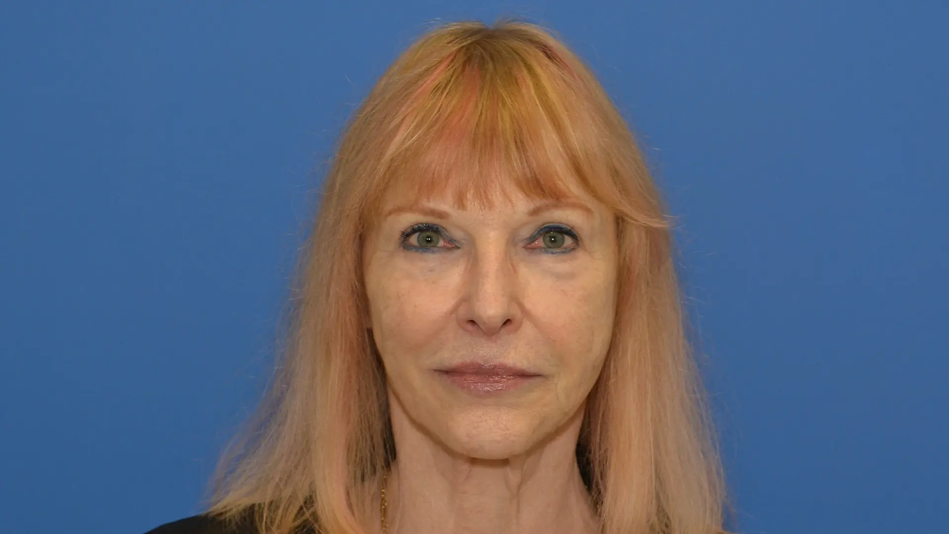 After Voluma before and after