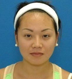 After Asian Blepharoplasty Transformations before and after
