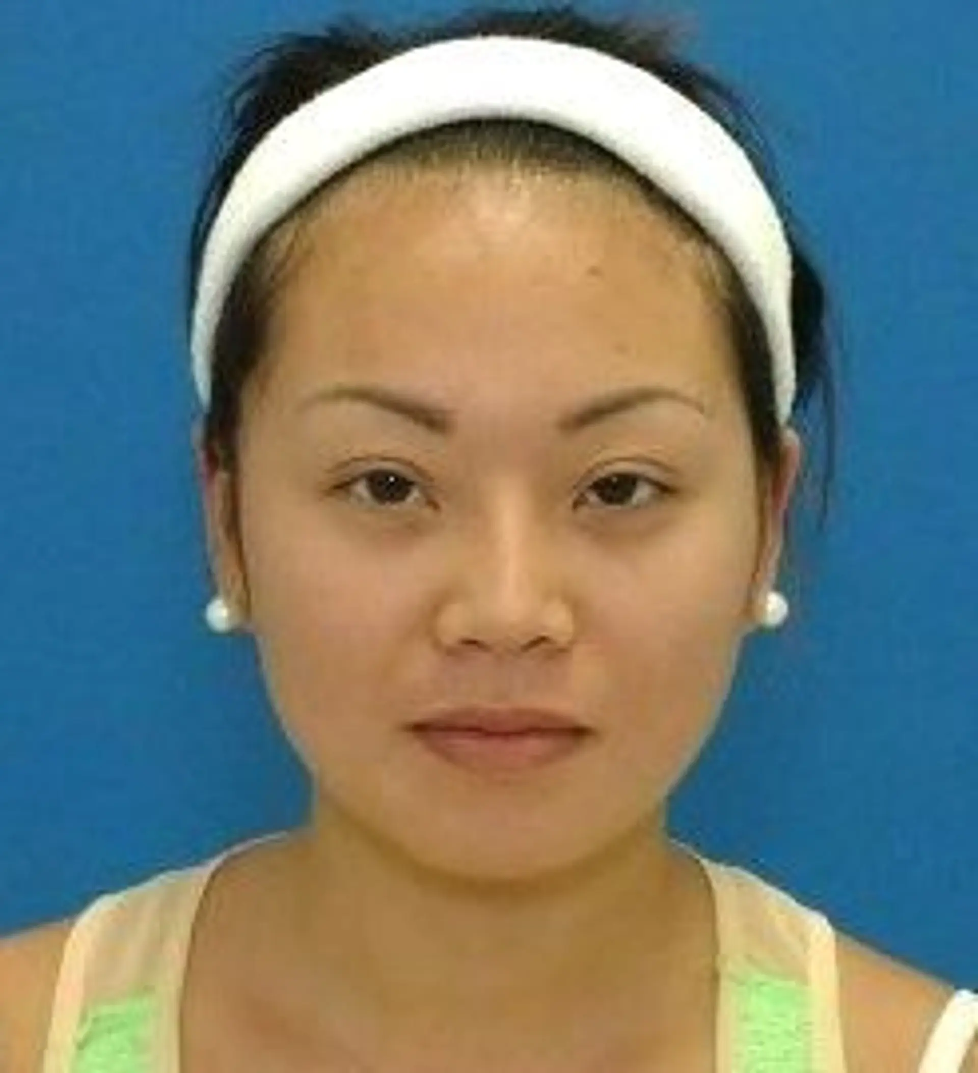 After Asian Blepharoplasty Transformations before and after