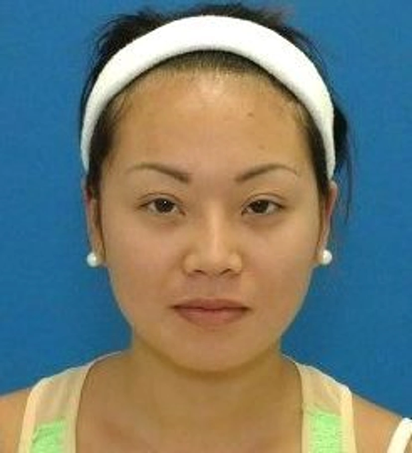 Asian Eyelid Surgery - Patient 1 (after front view)