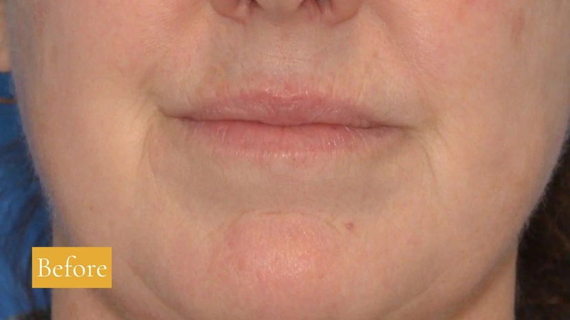 CO2 - Patient 1 (before)