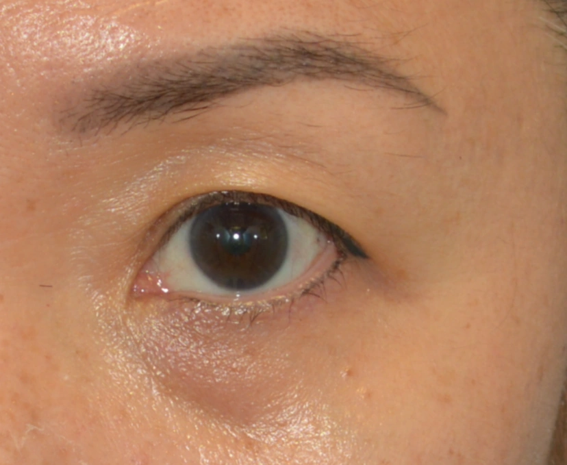 Asian eyelid surgery patient 52 result photo